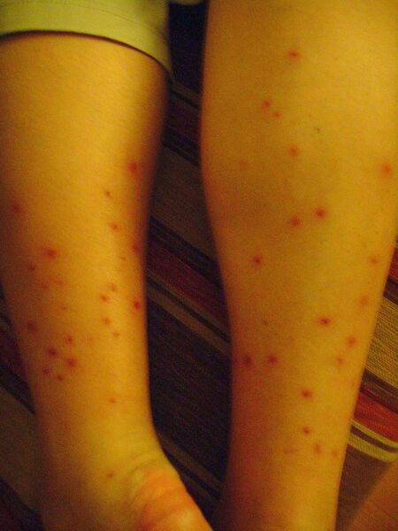 Mina mosquitobitna ben...inte skönt! -  - Peru